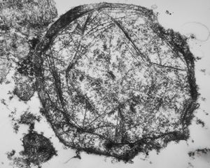 F,76y. | intranuclear needle-like structures - rhabdomyoma,tongue